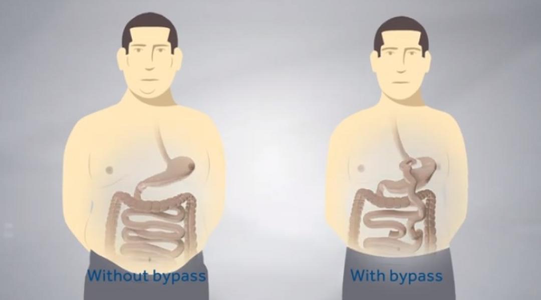 gastric bypass