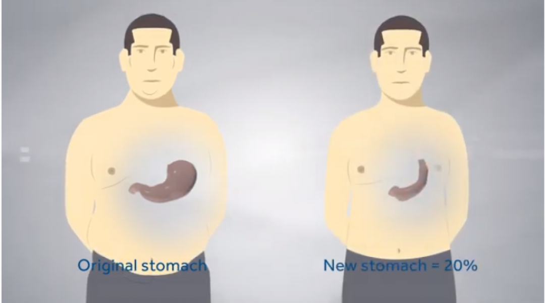 sleeve gastrectomie
