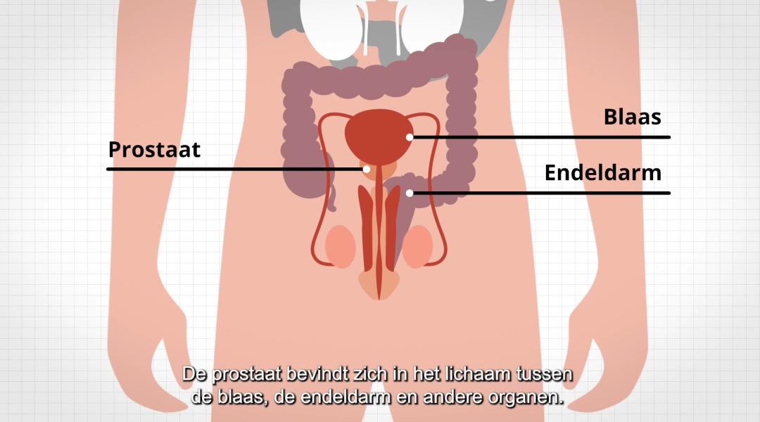 video prostaatkanker behandeling met radiotherapie